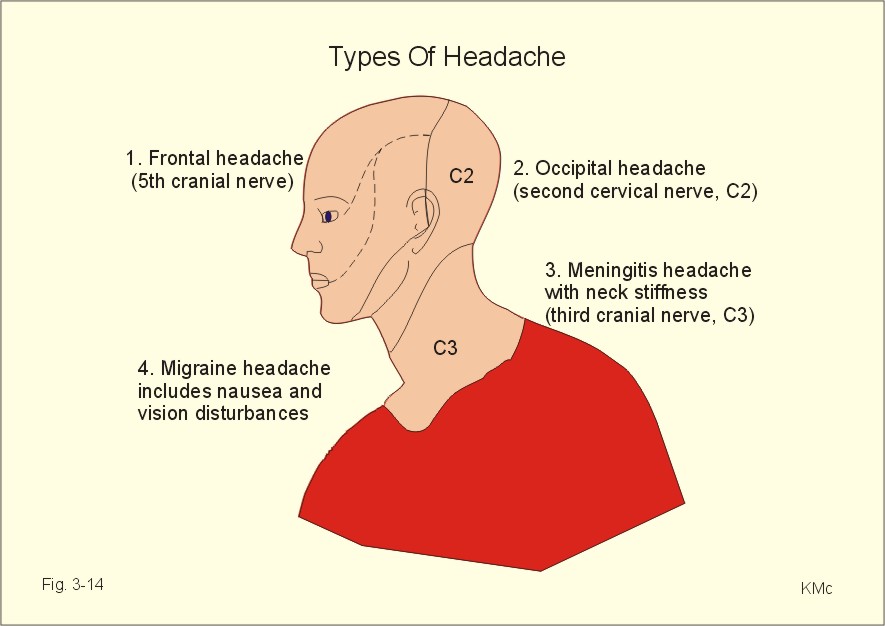 Physiology Of Headaches By Dr Beachy