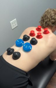 suction cups used for cupping therapy
